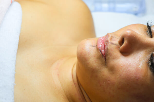 Before-and-after facial treatment application at NOBU Escazú, a Costa Rica esthetics salon and spa